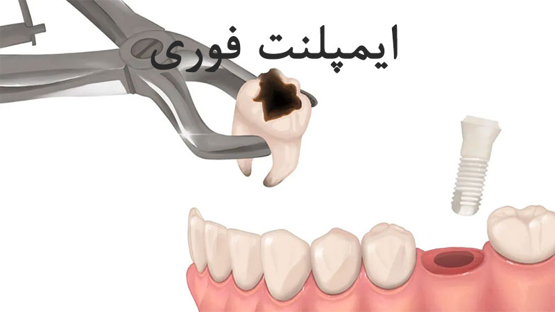 ایمپلنت فوری