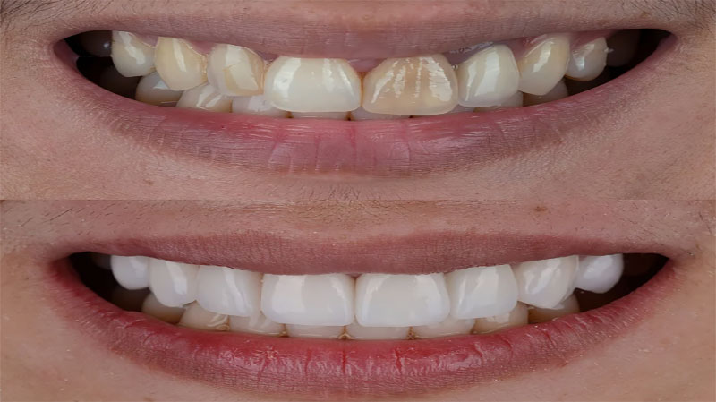مزایای لمینت کامپوزیتی دندان
