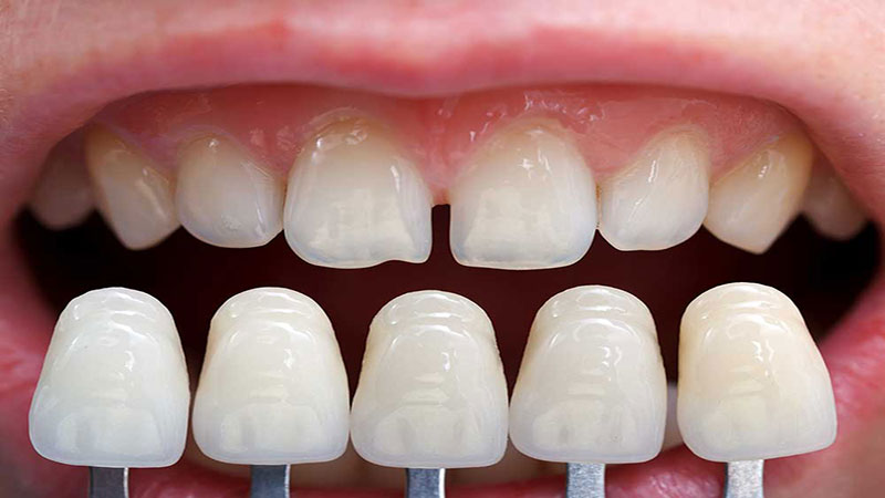 میزان تراش دندان ها 