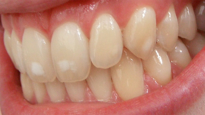  یکسان نبودن رنگ و ساختار تمامی دندان‌ها
