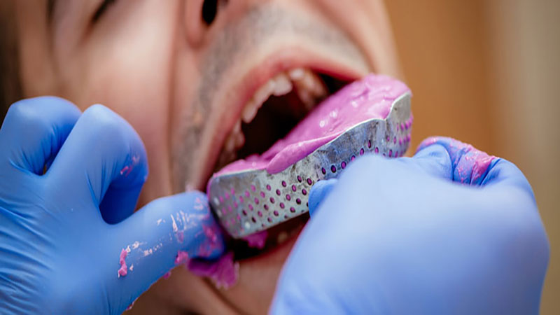  قالب‌گیری دندان‌ها