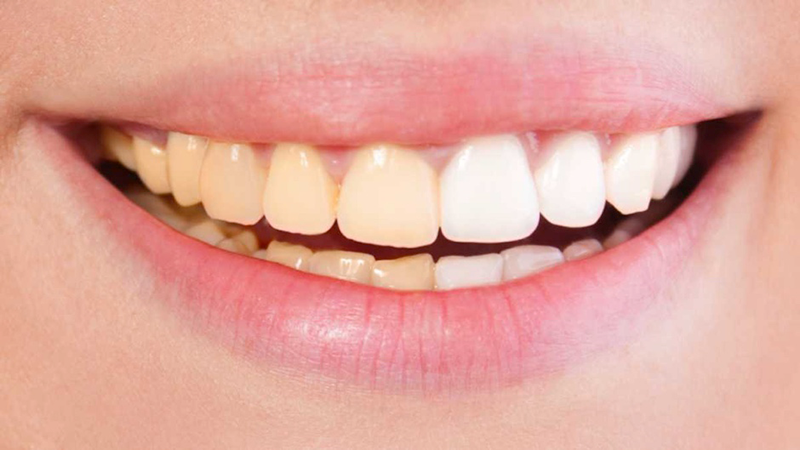 اصلاح رنگ دندان ها