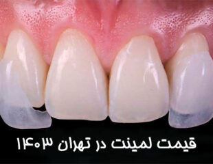 قیمت لمینت دندان در تهران 1403