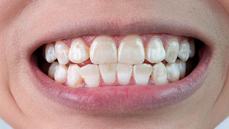 تغییر رنگ دندان‌ها پس از ارتودنسی